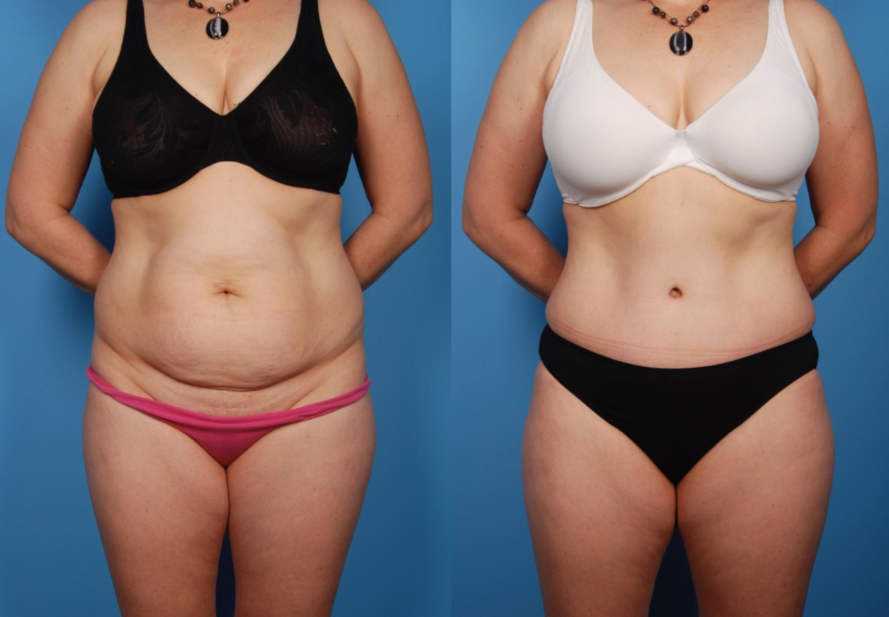 Achieving a Tauter Abdomen: Exploring the Benefits of Tummy Tuck Surgery